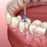 130664841-endodontic-root-canal-treatment-process-medically-accurate-tooth-3d-illustration-