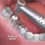 dental-implant