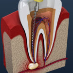 root-canal-main